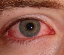 Eye Redness: Causes, When to See a Doctor, and Treatment